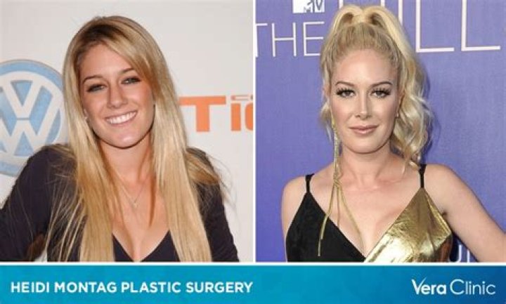 Heidi Montag Before and After Surgery: Navigating the Reality TV Star’s Transformation