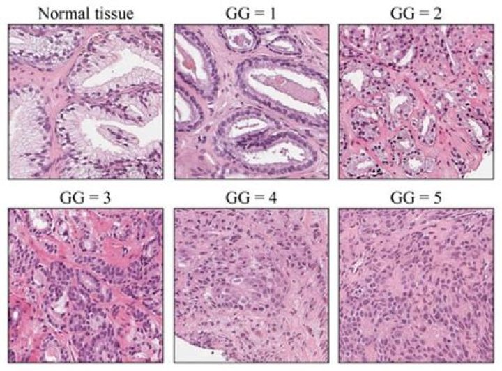 Loss of Sef (similar expression to FGF) expression is associated with high grade and metastatic prostate cancer - ePrints