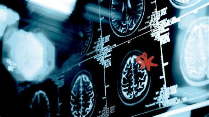 Reading the Brain: FDA Approves First Scan for Diagnosing ADHD