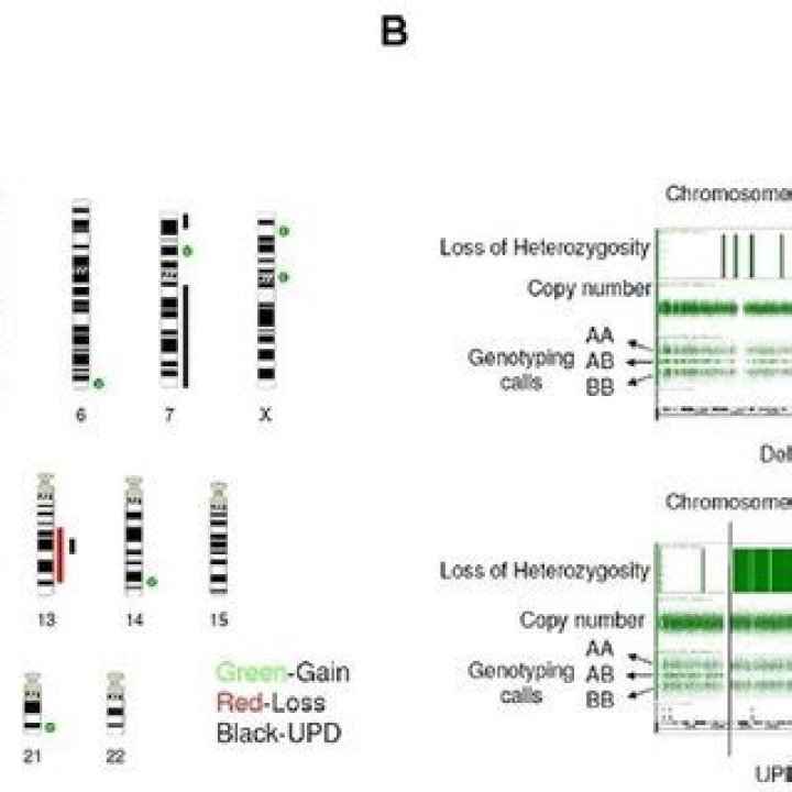 Single Nucleotide Polymorphism Array-Based Signature of Genetic Ploidy Groups in Acute Lymphoblastic Leukemia - ePrints