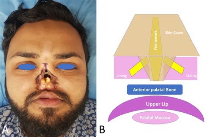 The proximal Peng flap: novel use of the Peng flap (pinch modification of advancement and rotation flaps) for proximal nasal dorsum defects in 14 patients - ePrints